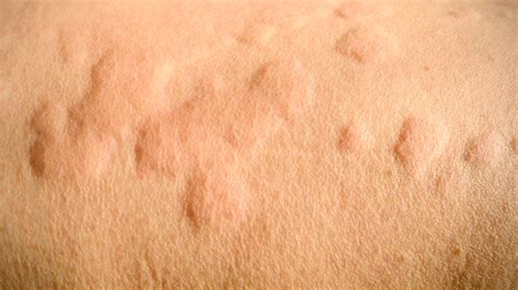 scratch test urticaria|what is urticaria unspecified.